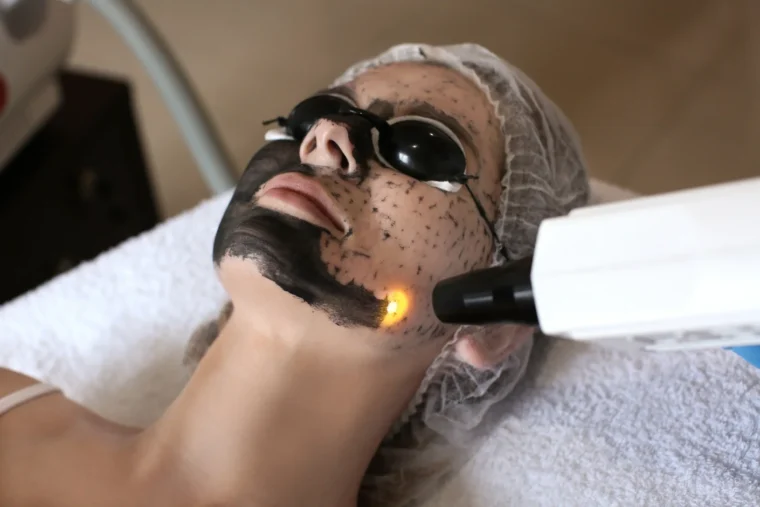 Cilt Güzelliğine Sıradışı Bir Dokunuş: Karbon Peeling’in Faydaları